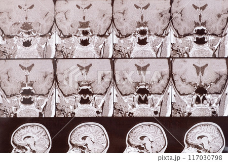Magnetic resonance imaging of the head of a healthy person, image of the pituitary gland. Magnetic resonance imaging of the head of a healthy person, image of the pituitary gland. 117030798