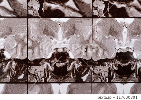 Magnetic resonance imaging of the head of a healthy person, image of the pituitary gland. 117030801
