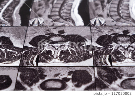 MRI of a patient with intervertebral disc protrusion and osteochondrosis of the thoracic spine MRI of a patient with intervertebral disc protrusion and osteochondrosis of the thoracic spine 117030802