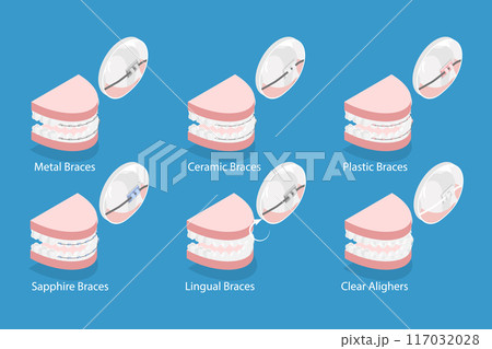 3D Isometric Flat Vector Illustration of Dental Teeth Braces Types, Orthodontic Options for Teeth Straightening 117032028