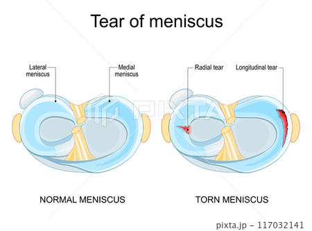 Meniscal tear. Torn meniscus. Knee injury. Meniscal tear. Torn meniscus. Knee injury. 117032141