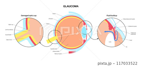 Glaucoma eye disease Glaucoma eye disease 117033522