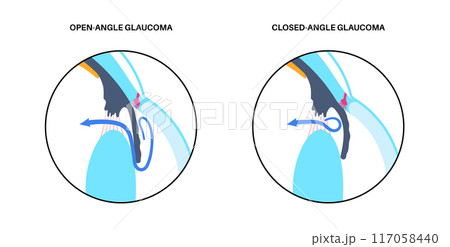 Glaucoma eye disease 117058440