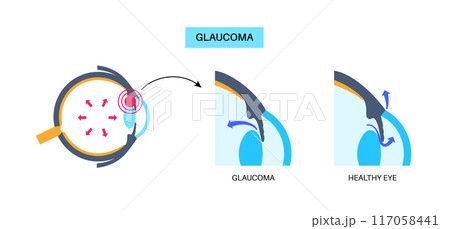 Glaucoma eye disease 117058441