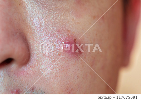 Asian man with inflamed acne and dark scar on cheek 117075691