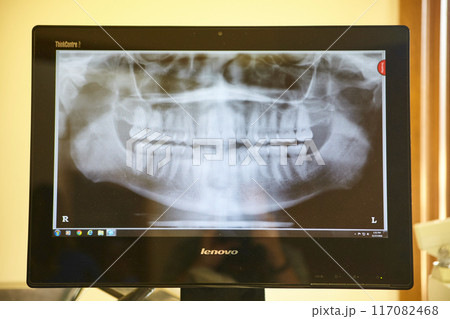 Panoramic Dental X-ray on Monitor in Clinic 117082468