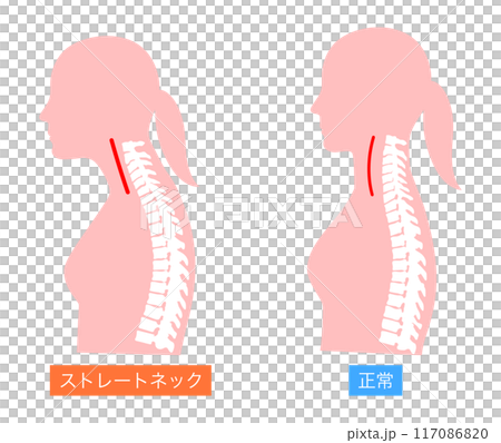 正常脖子和直脖子的女人上半身比較圖 正常脖子和直脖子的女人上半身比較圖 117086820