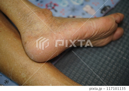 皮 肌 スキン 117101135