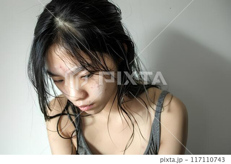 ニキビに悩む10代の女の子 AI生成 ニキビに悩む10代の女の子 AI生成 117110743