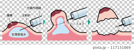 Endoscopic mucosal resection (EMR) - Illustrated Endoscopic mucosal resection (EMR) - Illustrated 117131869