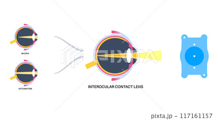 EVO ICL poster 117161157