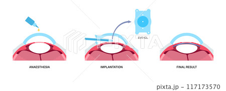 EVO ICL poster 117173570