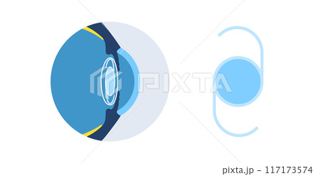 Intraocular lens poster Intraocular lens poster 117173574