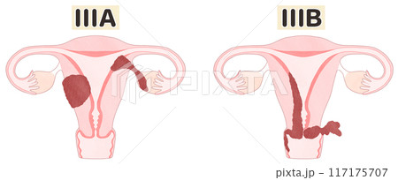 子宮体がんステージ3A・3B(ⅢA・ⅢB) わかりやすい図解イラスト 子宮体がんステージ3A・3B(ⅢA・ⅢB) わかりやすい図解イラスト 117175707