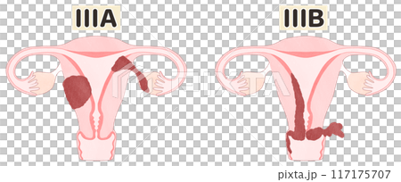 子宮体がんステージ3A・3B(ⅢA・ⅢB) わかりやすい図解イラスト 子宮体がんステージ3A・3B(ⅢA・ⅢB) わかりやすい図解イラスト 117175707