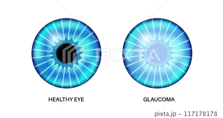 Glaucoma eye disease 117178178