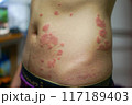 皮膚疾患 117189403