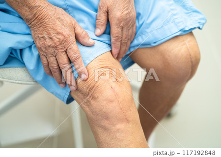 Asian elderly woman patient show her scars surgical total knee joint replacement Suture wound surgery arthroplasty. Asian elderly woman patient show her scars surgical total knee joint replacement Suture wound surgery arthroplasty. 117192848