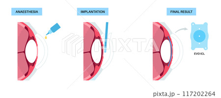 EVO ICL poster 117202264