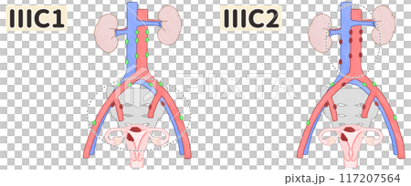 子宮体がんステージ3C1・3C2（ⅢC1・ⅢC2）　わかりやすい図解イラスト 117207564