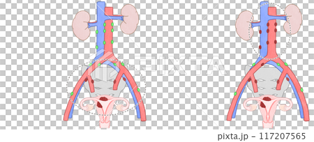 子宮体がんステージ3C1・3C2(ⅢC1・ⅢC2) わかりやすい図解イラスト 子宮体がんステージ3C1・3C2(ⅢC1・ⅢC2) わかりやすい図解イラスト 117207565