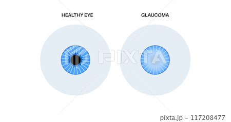 Glaucoma eye disease 117208477
