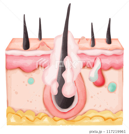 Watercolor Illustration of a Hair Follicle with Sebaceous Gland Infection 117219961