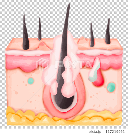 Watercolor Illustration of a Hair Follicle with Sebaceous Gland Infection 117219961