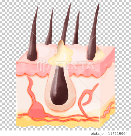 Watercolor Illustration of Hair Follicle with Sebum Buildup and Acne 117219964