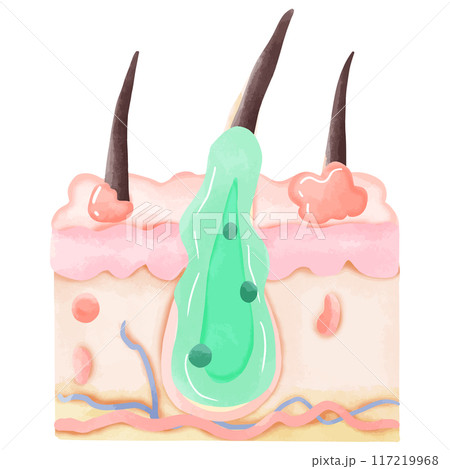 Watercolor Illustration of Inflamed Hair Follicle with Pus 117219968