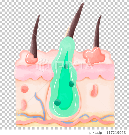 Watercolor Illustration of Inflamed Hair Follicle with Pus 117219968