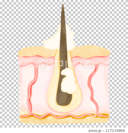 Watercolor Illustration of Hair Follicle with Sebum Overproduction 117219969