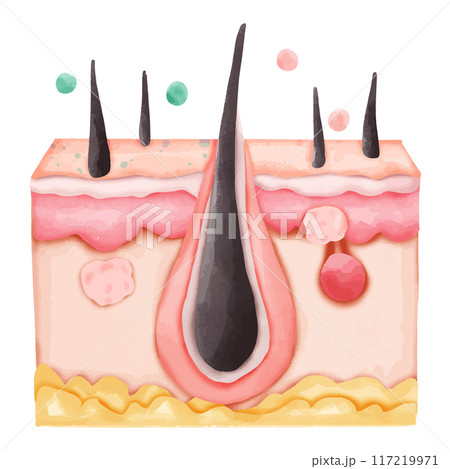 Watercolor Illustration of Hair Follicle with Clogged Pore and Pimples 117219971