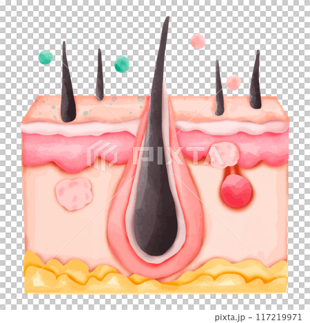 Watercolor Illustration of Hair Follicle with Clogged Pore and Pimples 117219971