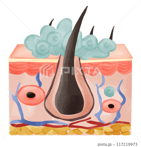 Watercolor Illustration of a Hair Follicle with Sebaceous Hyperplasia 117219973
