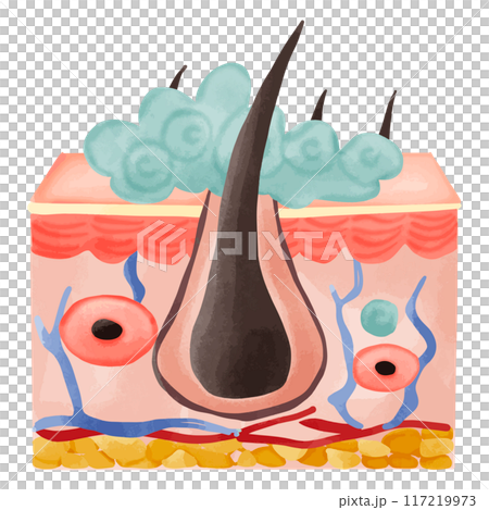 Watercolor Illustration of a Hair Follicle with Sebaceous Hyperplasia 117219973