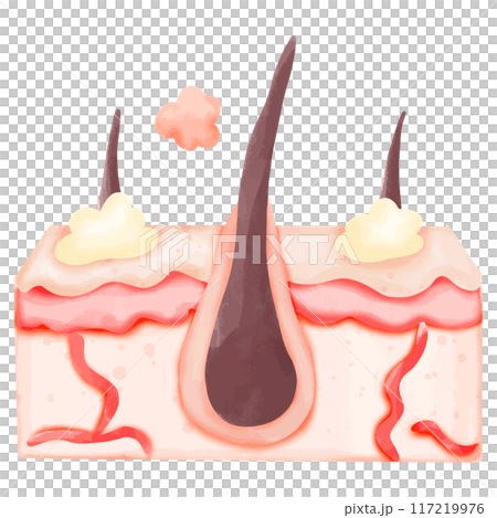 Watercolor Illustration of Hair Follicle with Sebum Build-up 117219976