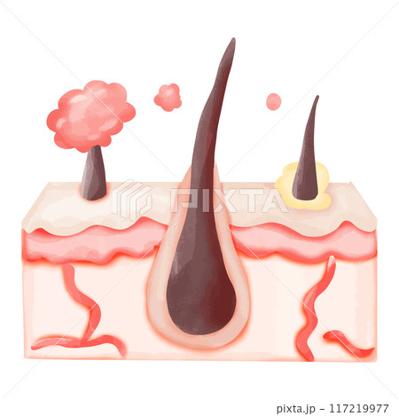 Watercolor Illustration of Hair Follicle with Ingrown Hair and Sebum Build-up Watercolor Illustration of Hair Follicle with Ingrown Hair and Sebum Build-up 117219977