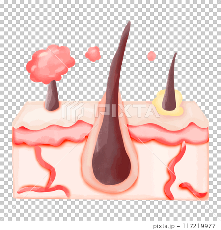 Watercolor Illustration of Hair Follicle with Ingrown Hair and Sebum Build-up Watercolor Illustration of Hair Follicle with Ingrown Hair and Sebum Build-up 117219977