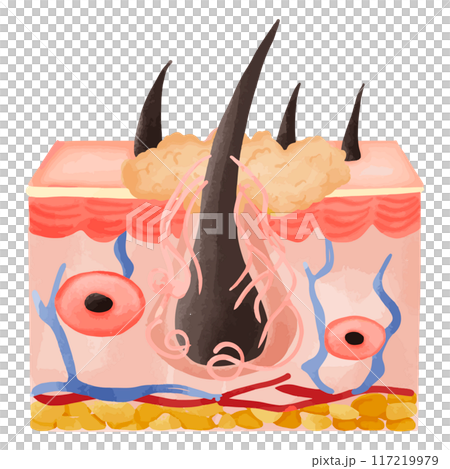 Watercolor Illustration of Hair Follicle with Deep Sebum Accumulation 117219979