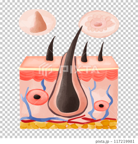 Watercolor Illustration of Hair Follicle with Follicular Hyperkeratosis 117219981
