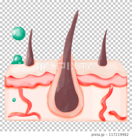 Watercolor Illustration of Hair Follicle with Bacterial Infection 117219982