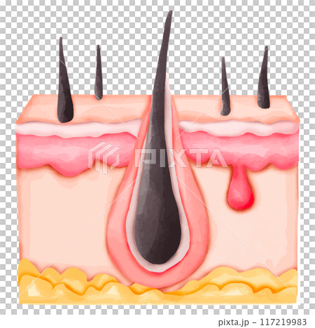 Watercolor Illustration of an Inflamed Hair Follicle with Sebaceous Cyst 117219983