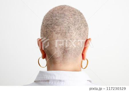 The back of a woman's head reveals extensive hair loss due to chemotherapy, 40 days into treatment. 117230329