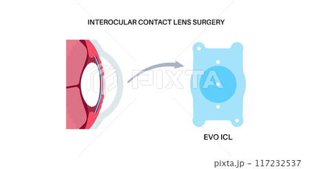 EVO ICL poster EVO ICL poster 117232537