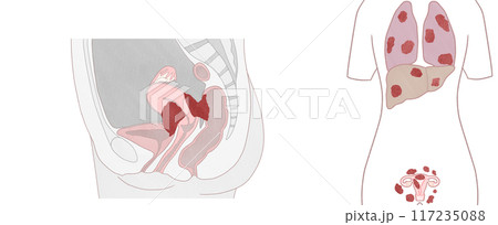 子宮体がんステージ4A・4B(ⅣA・ⅣB) わかりやすい図解イラスト 子宮体がんステージ4A・4B(ⅣA・ⅣB) わかりやすい図解イラスト 117235088