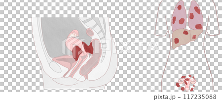 子宮体がんステージ4A・4B(ⅣA・ⅣB) わかりやすい図解イラスト 子宮体がんステージ4A・4B(ⅣA・ⅣB) わかりやすい図解イラスト 117235088