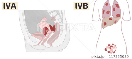 子宮体がんステージ4A・4B（ⅣA・ⅣB）　わかりやすい図解イラスト 117235089