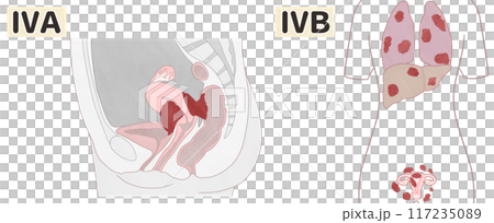 子宮体がんステージ4A・4B（ⅣA・ⅣB）　わかりやすい図解イラスト 117235089