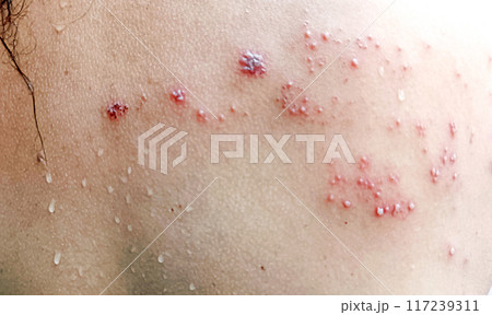 A Close up view of women with shingles (herpes zoster) disease on skin and he feel very painful A Close up view of women with shingles (herpes zoster) disease on skin and he feel very painful 117239311